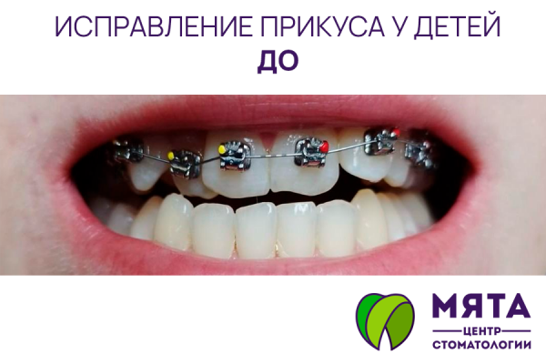 Исправление прикуса