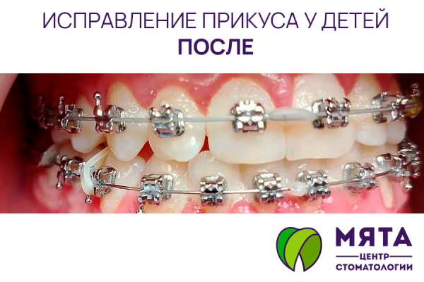 Исправление прикуса