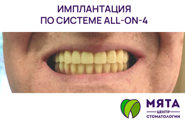 Имплантация All-on-4 (все на 4 имплантах)